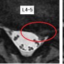 왼쪽허리통증 님의 요추디스크 L4-5, L5-S1의 MRI사진 판독입니다. 이미지