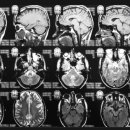뇌종양/교모세포종의 진단과 치료 과정 그리고 투병 관리 이미지