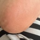 신지약국 | 무좀 스프레이 발뒤꿈치 각질 관리 후기