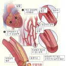 소리 없이 가슴에 드는 '멍' - 협심증(狹心症) 이미지