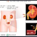 갱신형 요로결석진단비보장 특별약관(요로결석의 정의 및 진단확정) 이미지