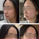 굿프라임2빌딩 | 신논현역피부과 프라임레이즈 레이저 리프팅 효과 가격 후기