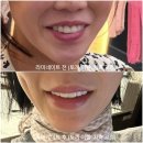 다온행복치과기공소 | 강남치과 내 치아처럼 자연스럽고 이쁜 블랑쉬 라미네이트 후기