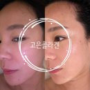 고은피부 - 이천시 중부대로1444번길 30 | 판교피부관리 MTS앰플케어 고은콜라겐 관리 후기