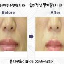 미러피부과성형외과 네이버블로그