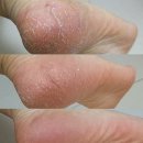 세진약국 | 터비뉴겔 발뒤꿈치 갈라짐 무좀 후기 (3달 경과)