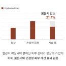 오브이메디컬 | 안면 홍조, 무조건 반복적 레이저 치료가 답일까요?