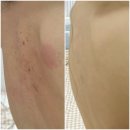 무등산한의원 | 광주 광천동 여드름 치료 ‘해율한의원’ 등드름 필링 1회차 후기