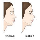 주걱턱[Class III malocclusion]성형미용 이미지
