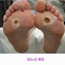 👣 당뇨환자, 발 질환의 증상과 원인 알아보기 이미지