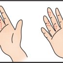 선천성 손 기형[Congenital hand anomaly]성형미용, 소아청소년질환 이미지