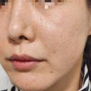 셀릭 | 압구정피부과 미라젯 쥬베룩 키닥터 리쥬셀릭 크림 후기