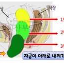 질이완 수술적 치료 이미지