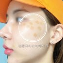 수원 편평사마귀 제거 일주일 차 : 무상리터치 : 관리방법