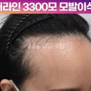 헤어라인 이미지