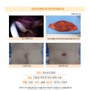 담낭선근종수술후기. 걱정 했던 것과 달리 수술직후 잠시 통증 외에 별다른 힘든 것 없이 입원할 수 있었습니다. 이미지