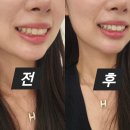 [내돈내산] 신사역 레브치과 치아미백으로 예비신부관리시작 :: 원데이 치아미백 솔직후기