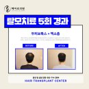 홍산의원 | 전주 모발이식 결정 전 지나야 할 생각의 과정