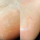 유리아 | 함익병 발보습제 발뒤꿈치 각질 유리아크림 가격 후기