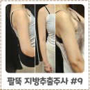예쁜눈만들기 | 팔뚝살빼는법 찾다가 선택한 지방추출주사 예쁜 뼈팔 만들기 성공 후기