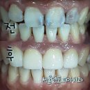 모아심미치과기공소 | 일산 서울대출신치과 앞니 충치로 인한 보철 앞니 심미보철 일산양심치과