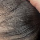 닥터모락합정점 | 두피 관리 | 닥터모락 합정점 20대 여자 탈모 관리 후기 (30회 탈모관리 변화, 가격, 관리순서, 관리...