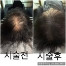 자연빛깔 - 광주시 | 부산 정수리탈모 smp두피문신 자연스럽게 잘하는곳(+후기)