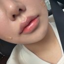 신논현역피부과 움직이는 부위에 강한 뉴비아 필러 팔자주름 + 귀족필러 일주일 후기