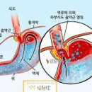 목에 걸린 느낌 무엇과 연관이 있을까 이미지