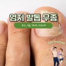 호정약국 | 엄지발톱 무좀 증상 치료 바르는약 먹는약 추천 경험 후기 예방방법 들려드려요