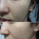 2&4룩 | 내돈내산 여드름 흉터 치료 2년 후 후기 | 큐어젯+쥬베룩 효과, 패인 흉터는 차올랐지만 잡티가..3탄