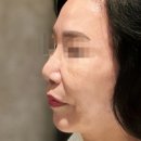 넥스 | 비개방코성형 넥스코성형 후기 | 중년 여성을 위한 코라인 교정, 비절개로 안전하게
