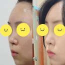레이디한의원 레이디코 일주일차 후기(내돈내산)
