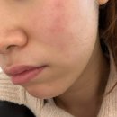 오르멜라 뷰티에스테틱(ORMELLA Beauty Aesthetic) 강남본점 | 신논현 두골비, 신논현 웨딩케어 ㅣ 오르멜라뷰티에스테틱 강남본점 LDM 물방울관리 후기