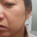 루비성형외과의원 | 압구정 라움 성형외과 흑자 잡티 제거 루비레이저 딱지 후기