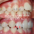 예닮치과병원 | 내돈내산 목포치아교정 예닮치과병원 솔직한 후기 금액비용 기타 정보