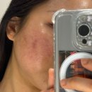 고고성형외과의원 | [논현역 피부과] 연말맞이 내돈내산 인모드 당일 후기 "시네마의원"