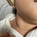 신생아 사경치료 - 대전 사경치료 (굿모닝재활의학과의원)