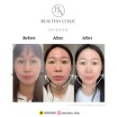 리우라인의원 | [뷰리안 시술 전후사진] 부산 실리프팅/용호동 실리프팅/경성대 실리프팅/부산 리프팅/실리프팅 가격...