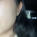 내안에 약초 | 광주 여드름 흉터 피부관리 약초필링 1차 후기 기록 중