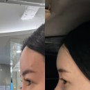 대구 이마필러 잘하는 곳 대구 중구 피부과 추천 이마필러3cc 맞고 온 후기