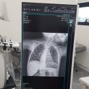 29개월아기 기관지염 일주일 넘게 열 + 폐렴, 바이러스검사 후기