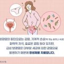 여성 방광염 만성 급성 원인 진단 이미지