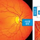 망막 사진을 볼땐, ‘컵’ 크기를 확인하세요 이미지