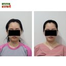 [공지] "수술없이 얼마나 달라질 수 있을까?" 유명 한의원에서 안면비대칭 관리 받고온 후기, 비포애프터