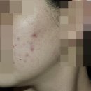 여드름 고민으로 강남 압구정피부과유명한곳 찾을 때 한의원도 살피면