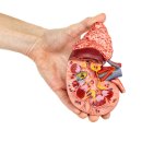 RR-82[경기동로]-상-219 | 급성신부전염(Acute renal failure) 케이스 스터디