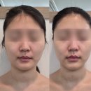 비칠영에스테틱 | 천안 수기 윤곽관리 잘하는 곳 비칠영 에스테틱 이마 볼륨효과 굿