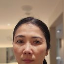 올림피움채움올피채의원 | 강남역피부과 올피채강남 피코슈어토닝 기미 잡티 개선 후기