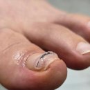 비룡로 59 | 남양주내성발톱 관리와 무좀 케어 함께한 후기